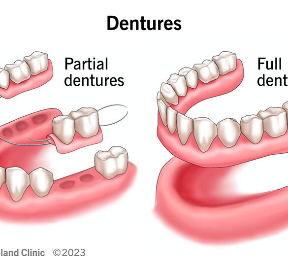 Dental Implants