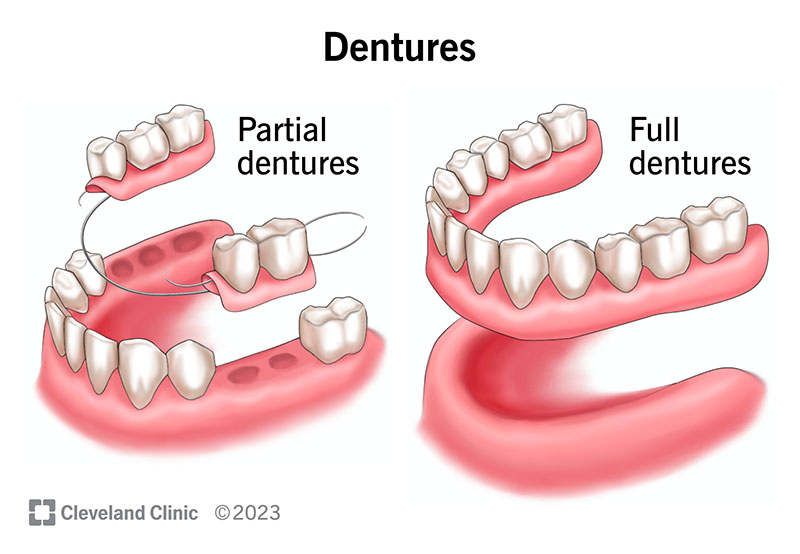 Dental Implants