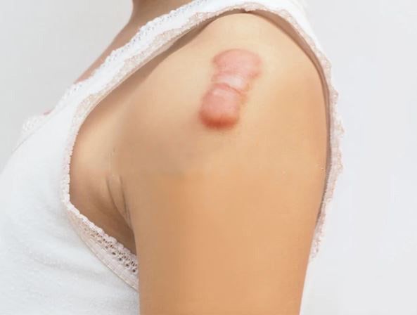 Keloid Treatment: Modern Solutions for Managing Tough Scars