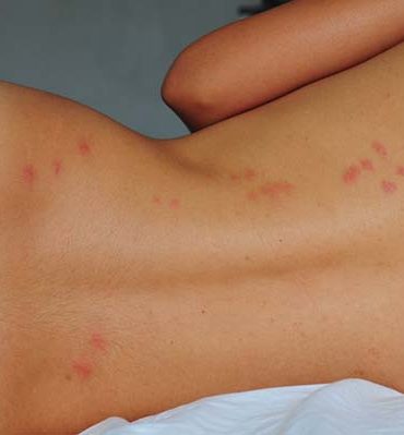 Bed Bug or Mosquito? How to Know What’s Really Biting You at Night