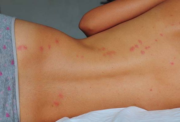 Bed Bug or Mosquito? How to Know What’s Really Biting You at Night