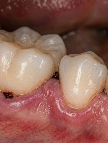 Silent Damage Below the Gums: How Bone Loss Develops Without Notice