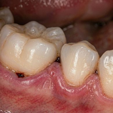 Silent Damage Below the Gums: How Bone Loss Develops Without Notice