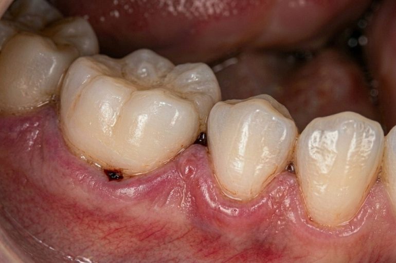 Silent Damage Below the Gums: How Bone Loss Develops Without Notice