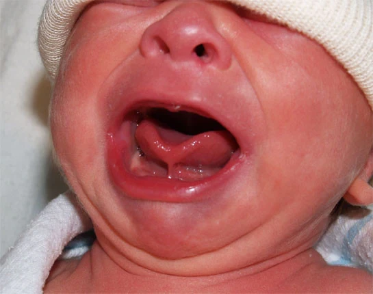 Can Baby Tongue-Tie Affect Sleep? What Every Parent Should Know