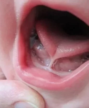 Tethered Oral Tissues: Trends, Truths, and Professional Training