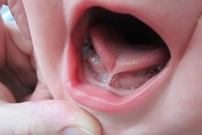 Tethered Oral Tissues: Trends, Truths, and Professional Training