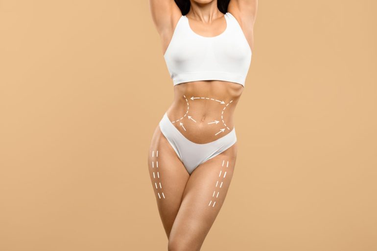 Liposuction